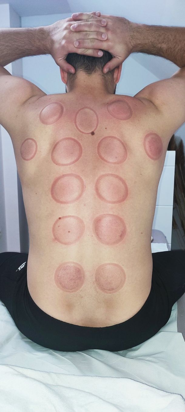 Suva hidzama - posle tretmana